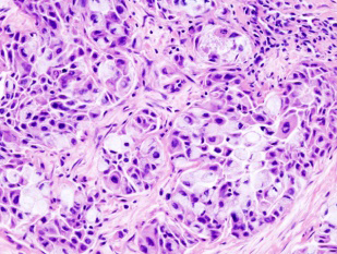 Figure 1: Mucoepidermoid carcinoma delineating an admixture of mucous cells, intermediate cells and epidermoid cells with minor component of clear cells, Tumour cells are imbued with pleomorphic nuclei. Fibrous tissue appears to encompass tumour cell aggregates [5].