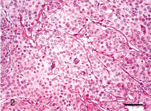 Figure 2: Mucoepidermoid carcinoma demonstrating an admixture of mucous cells, intermediate cells and epidermoid cells with intermingled mucoid substance. Pleomorphic nuclei and a component of clear cells is observed. Tumour parenchyma is traversed by vascularized fibrous tissue septa [6].