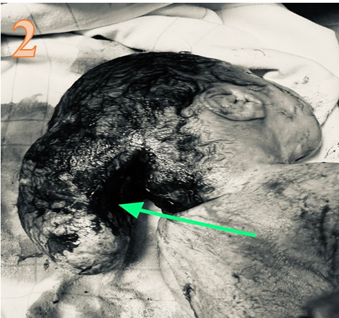 Figure 3: Appearance of Polydactyly on Upper and Lower Limbs (6).