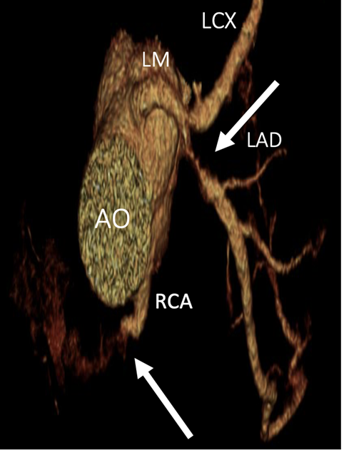 Figure 1: 3D Coronary Tree.
