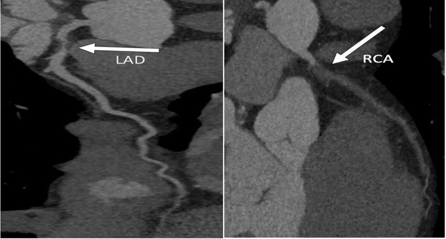 Figure 2: Curved MPR of LAD and RCA.
