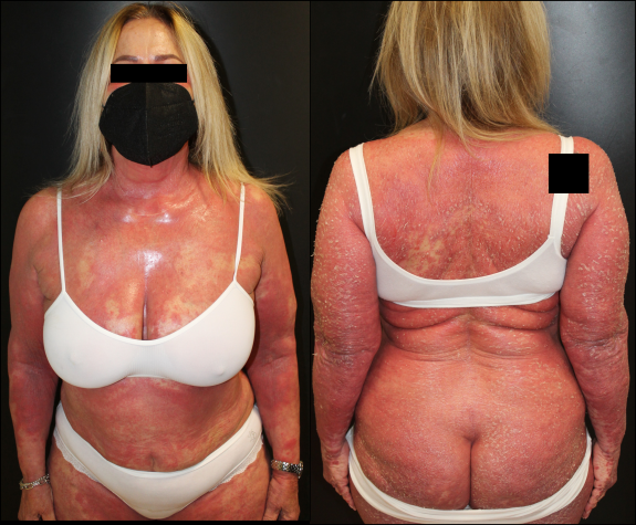 Figure 1: Eczematous eruption after secukinumab.
