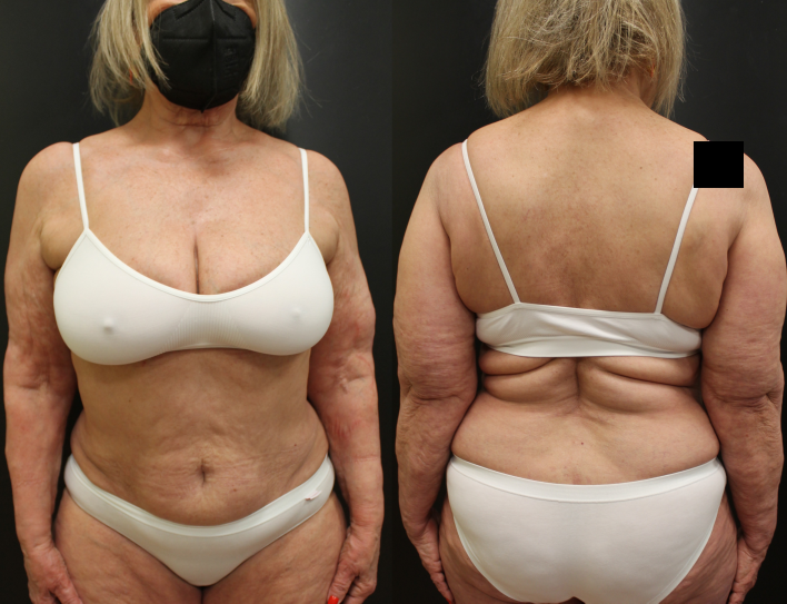 Figure 3: After 4 weeks of guselkumab only.