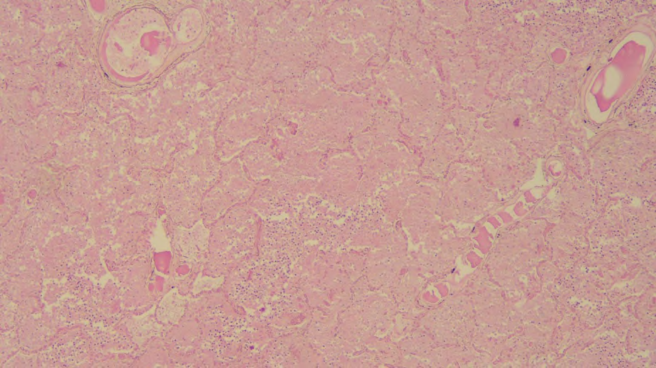 Figure 6: Photomicrographs of the Esophageal Lesion ((A) H&E, 40X; (B) H&E, 100X). The Esophageal Mucosa Presented Complete Necrosis of the Superficial Epithelium with Intense Inflammation in the Submucosa and Proper Muscularis.