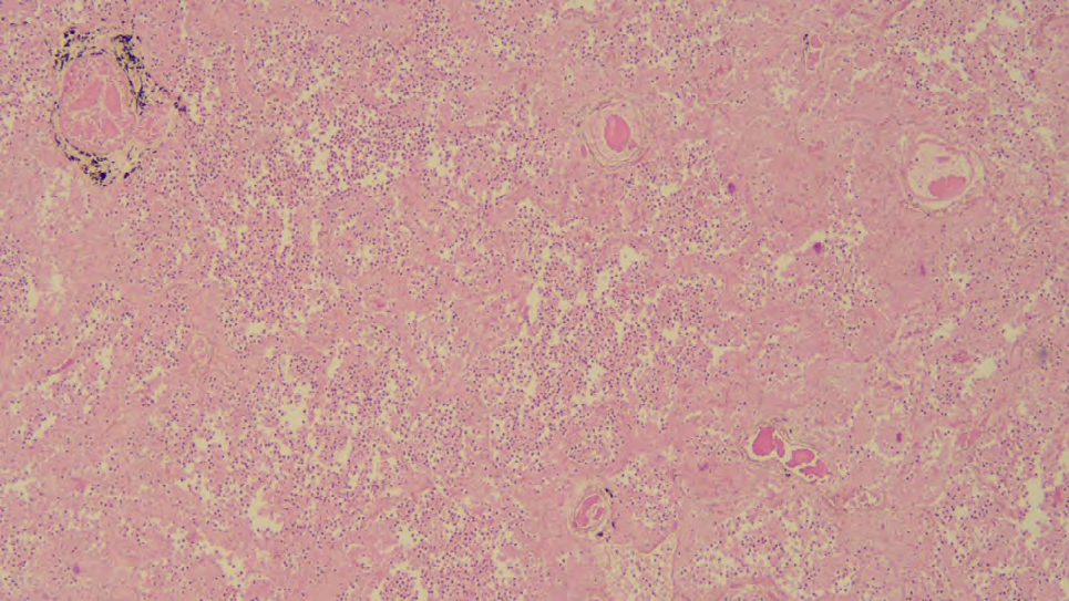 Figure 7: Photomicrographs of the Laryngeal Lesion ((A) H&E, 40X; (B) H&E, 100X). The Laryngeal Mucosa Presented Complete Necrosis of the Mucosa and Submucosa with Intense Inflammation.