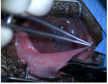 Figure 1: ** Tenon’s Fascia Being Dissected from the Bulbar Conjunctiva Using Westcott Scissors for Placement of the Pedicle Graft.