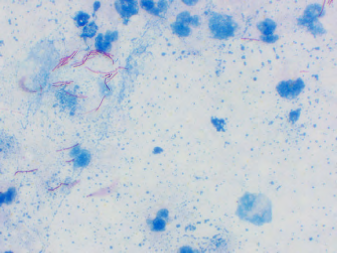 Figure 1: The image shows magenta coloured acid- fast rod-shaped bacillus forming heaps of small rods- mycobacterium tuberculosis.