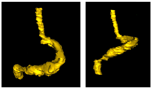 Figure 3: Case 1: 3D reconstruction model of laparoscopic vertical gastrectomy with no evidence of complication.