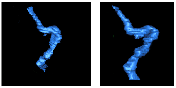 Figure 4: Case 2: 3D reconstruction model of laparoscopic vertical gastrectomy with suspicion of partial stenosis.