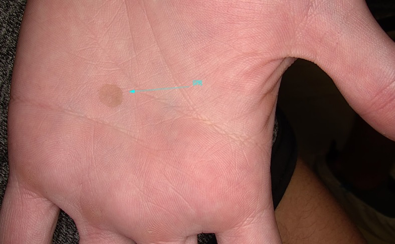 Figure 1: Slightly scaly hyperchromic macula, with ill- defined borders, with a maximum diameter of 10mm, on the right palm.