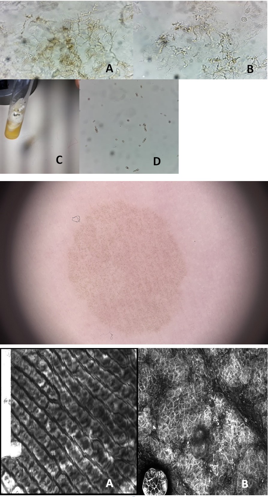 Figure 2: Non melanocytic pattern with speckled and superficial pigmentation.