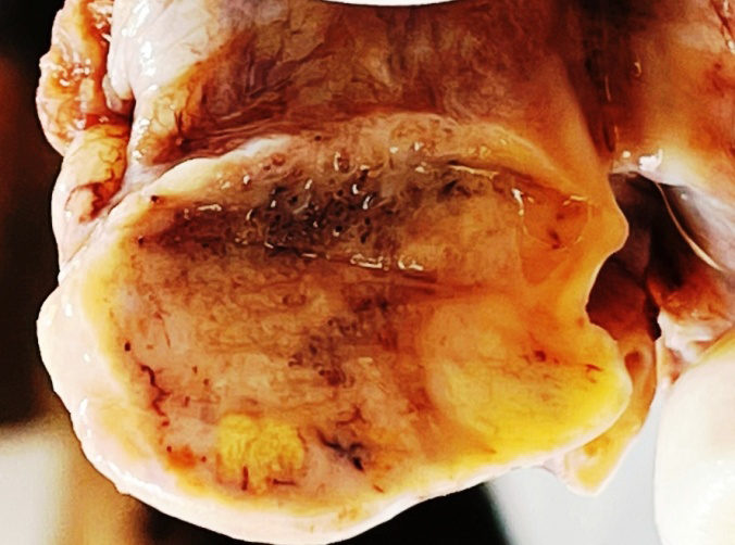 Figure 1: Right ovary shows well-circumscribed tumor with a smooth lobulated outer surface, homogenous, solid, firm, tan- yellowish on cut surface.
