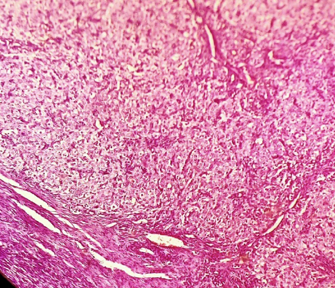 Figure 2: Right ovary tumor composed of nodules of Leydig cells with a neoplastic stromal proliferation( hematoxylin and eosin staining, magnification ×100)