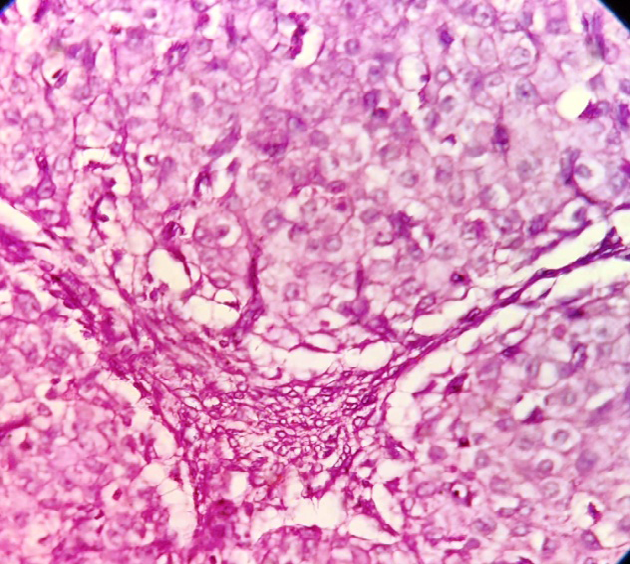 Figure 3: The neoplatic cells are of uniform round with abundant eosinophilic cytoplasm. The nuclei are round, uniform, having prominent central nucleoli (hematoxylin and eosin staining, magnification ×400).