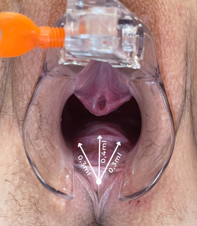 Figure 2: The injection of HA was performed in retroinjection, in 3 vectors, 1 central, which received about 0.4ml of HA and 2 lateral to the described one, which received 0.3ml each. The injection was performed only on the posterior wall, trying to distribute the HA only in the distal 5 cm of the vagina, where women have major complaints of dryness.