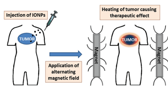 Figure 2: Scheme of cancer therapy by hyperthermia using SIONP [22].
