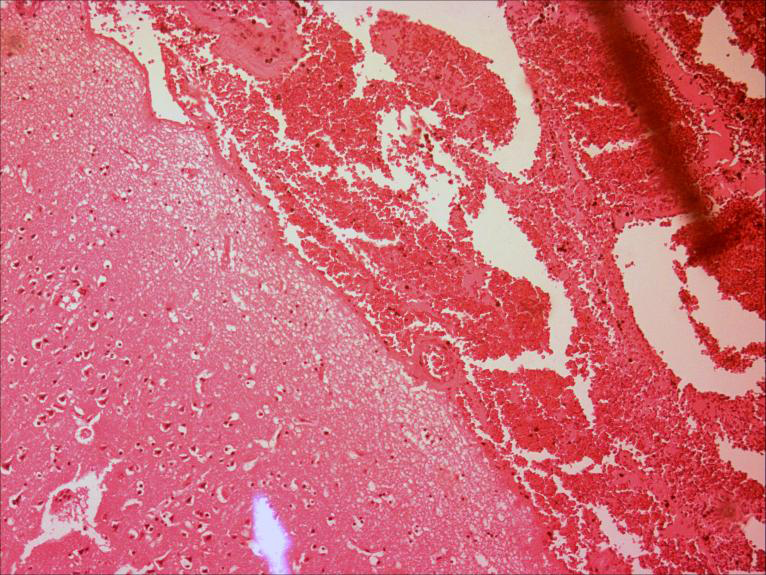 Figure 2: Meningeal Vascular and Parenchymal Vascular Highly Congested.