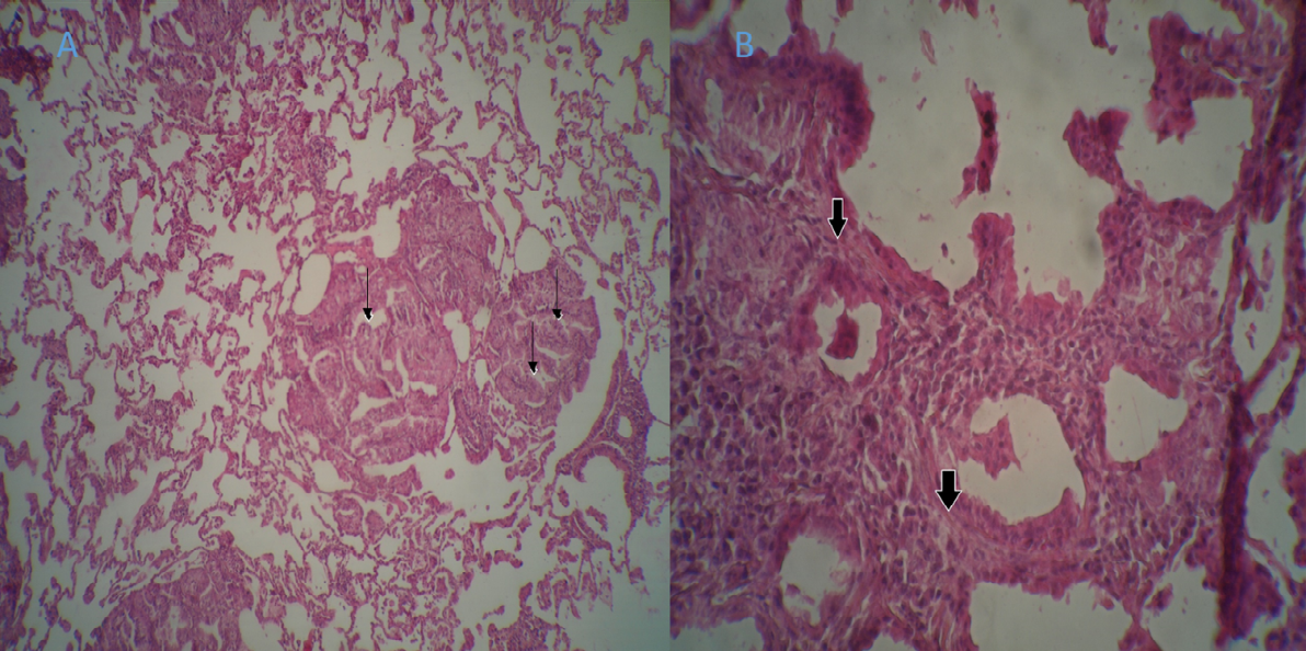 Figure 4: A) papillary protrusions consisting of short cuboid to columnar cells are seen inside the alveolar space, 4x magnified, B) the presence of a scattered stroma of connective tissue around the alveoli is observed, 10x magnified.