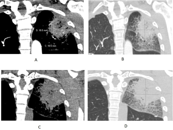 Figure 1: CT chest with coronal reformat at first day of admission (A and B) revealed left upper lobe (LUL) consolidative opacity measures 4.1x4.0 cm with a central area of heterogeneous gas density measures 1.9x1.9 cm. Mild surrounding ground glass and septal thickening. Four days later, Interval increase of LUL opacity (C and D) measures 6.2x5.7 cm and central heterogeneous gas density measures 1.6x1.3 cm. interval increase of surrounding septal thickening and ground glass densities.