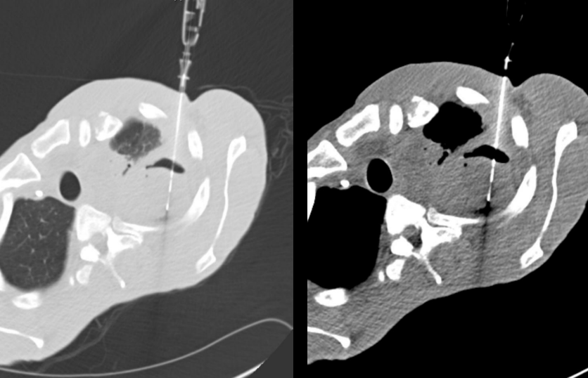 Figure 4: CT guided biopsy of LUL cavitary lesion.