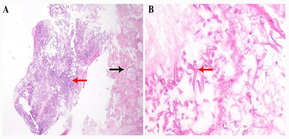 Figure 5: Biopsies from the lung (Hematoxylin & eosin-stained sections A [magnification x40] and B [magnification x400]) revealed extensive necrotic lung parenchyma (black arrow) involved by numerous broad aseptate fungal hyphae (red arrows), morphologically consistent with mucormycosis.