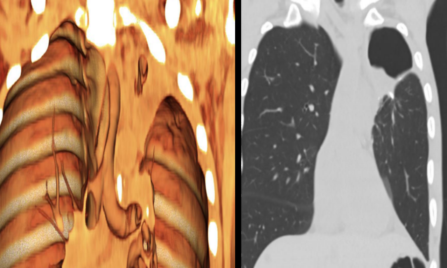 Figure 6: CT chest post-operative coronal reformat (left) and 3D VR image (right). Interval post-operative changes of left upper lobectomy with evolving post-operative changes and decrease in size of lobectomy space and expansion of the LLL in the left hemithorax.