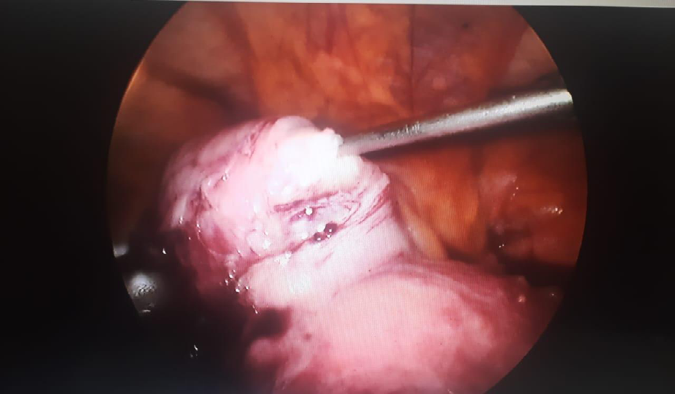 Figure 1: Myoma being enucleated with the help of myoma screw.