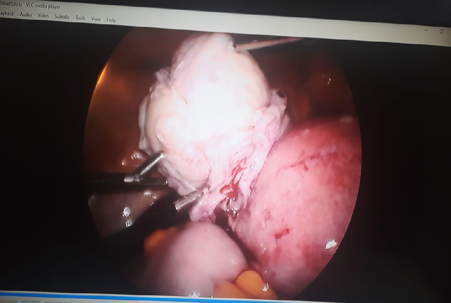 Figure 2: Myoma completely separated from the surface of uterus.