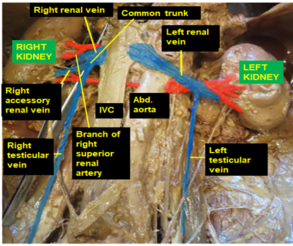 Figure 1: A photographic illustration of the retroperitoneal cavity showing the right testicular vein joining the right accessory renal vein to form a common trunk that opened into the right renal vein and a branch of the right superior renal artery crossing ventral to the right renal vein to enter the hilum. It also illustrates the left renal vein descending ventral to the left renal arteries and then turning around the arteries to enter the hilum dorsal to the arteries.