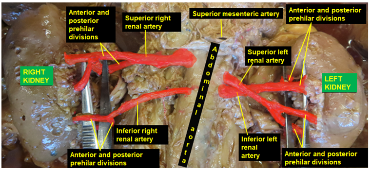 Figure 2: A photograph of the retroperitoneum showing the bilateral duplication of renal arteries and their anterior and posterior prehilar divisions. It also illustrates the intercrossing left renal arteries after originating from the left side of the abdominal aorta.