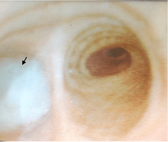Figure 1: Left Main Stem Bronchus Secretions Lot of Secretions in Showed in Arrow.