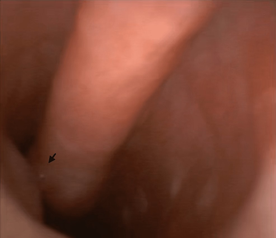 Figure 2: Severe Posterior Wall Tracheomalacia. Arrow Indicate Posterior Tracheal Wall Touching the Anterior Tracheal Wall.