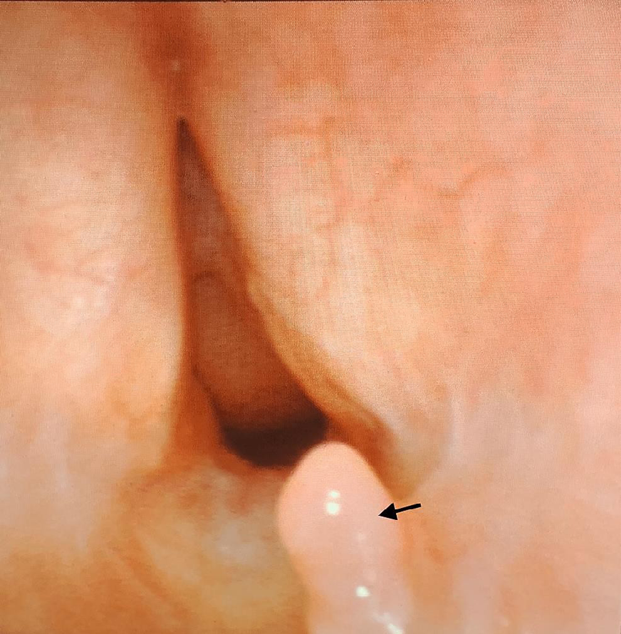 Figure 3: Retroflexion through Tracheal Stoma-Sub Glottic View Arrow Indicate Sub Glottic Granulations.