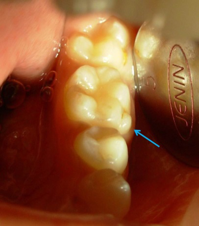Figure 1: Intraoral Photograph Showing Presence of Protoconidal Cingulum/Protostylid in the Permanent Mandibular Left First Molar (Blue Arrow) as Seen from Occlusal View.