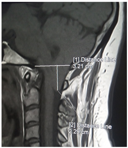 Figure 1: ** C spine MRI image showing sagittal measurement of cerebellar tonsil.