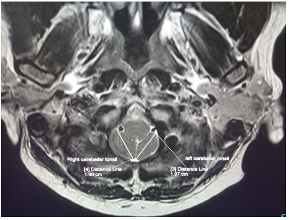 Figure 2: ** C spine MRI image showing measurement of the longest length of cerebellar tonsils in axial plane.