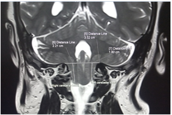 Figure 3: ** C spine MRI image showing measurement of the longest length of cerebellar tonsils in coronal plane.