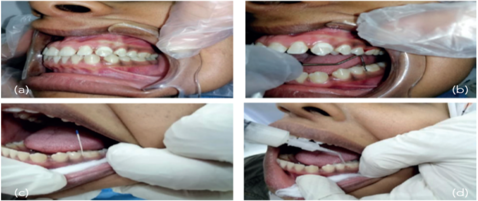 Figure 3: MINST + EMD application: (A,B) Initial clinical and radiographic images; (C) Use of ultrasonic delicate tip; (D) Use of mini curette; (E) After MINST (notice the minimal tissue trauma); (F) EDTA application; (G) Dried tooth surface; (H) EMD application; (I,J) Clinical and radiographic images at 12 months.