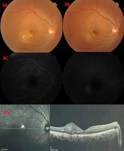 Figure 2: Fundus images of the right eye prior to intravitreal conbercept injection. A: Fundus images revealed a prominent nodular lesion with some calcifications. B: Fundus autofluorescence imaging revealing hyperautofluorescence. C: FFA revealed hypofluorescencent occlusion during the early phase (left) and marked neovascular vessel leakage in the late phase. D: Horizontal OCT images through the fovea revealing macular edema (upper) with a dome-shaped hyperreflective mass associated with retinal disorganization, posterior shadowing, and “moth-eaten: spaces.