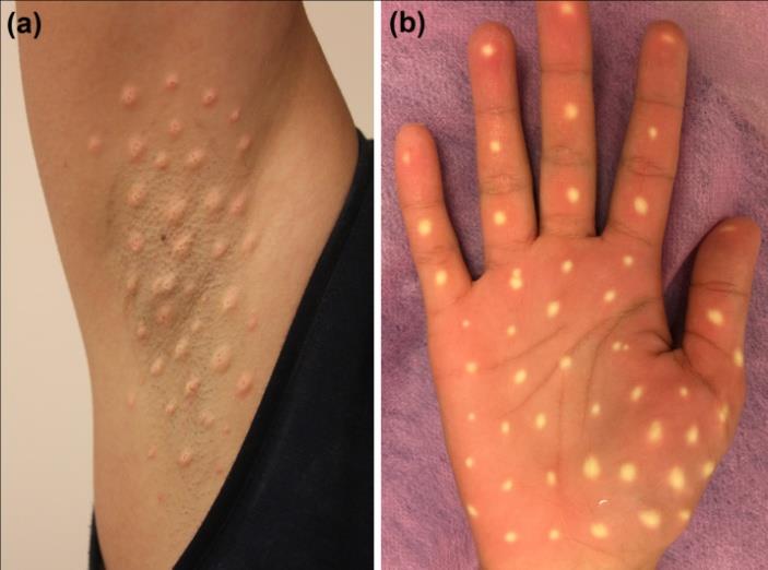 Figure 1: Skin papule in axillary and palmar areas following EnerJet administration.