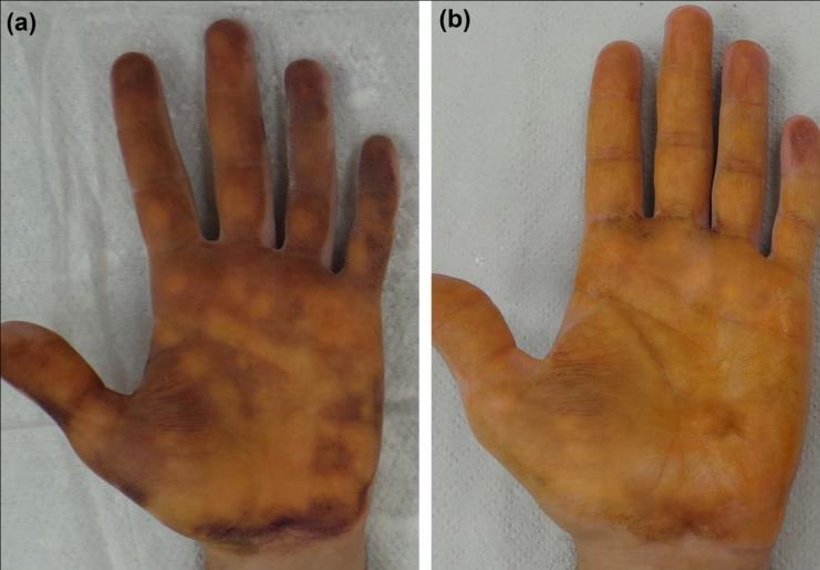 Figure 2: Palmar hyperhidrosis (45-yo male). Minor test before treatment (A) and at follow-up (B).