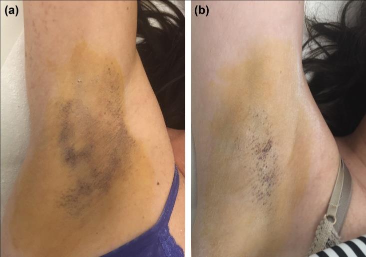 Figure 3: Axillary hyperhidrosis (36-yo female). Minor test before treatment (A) and at follow-up (B).