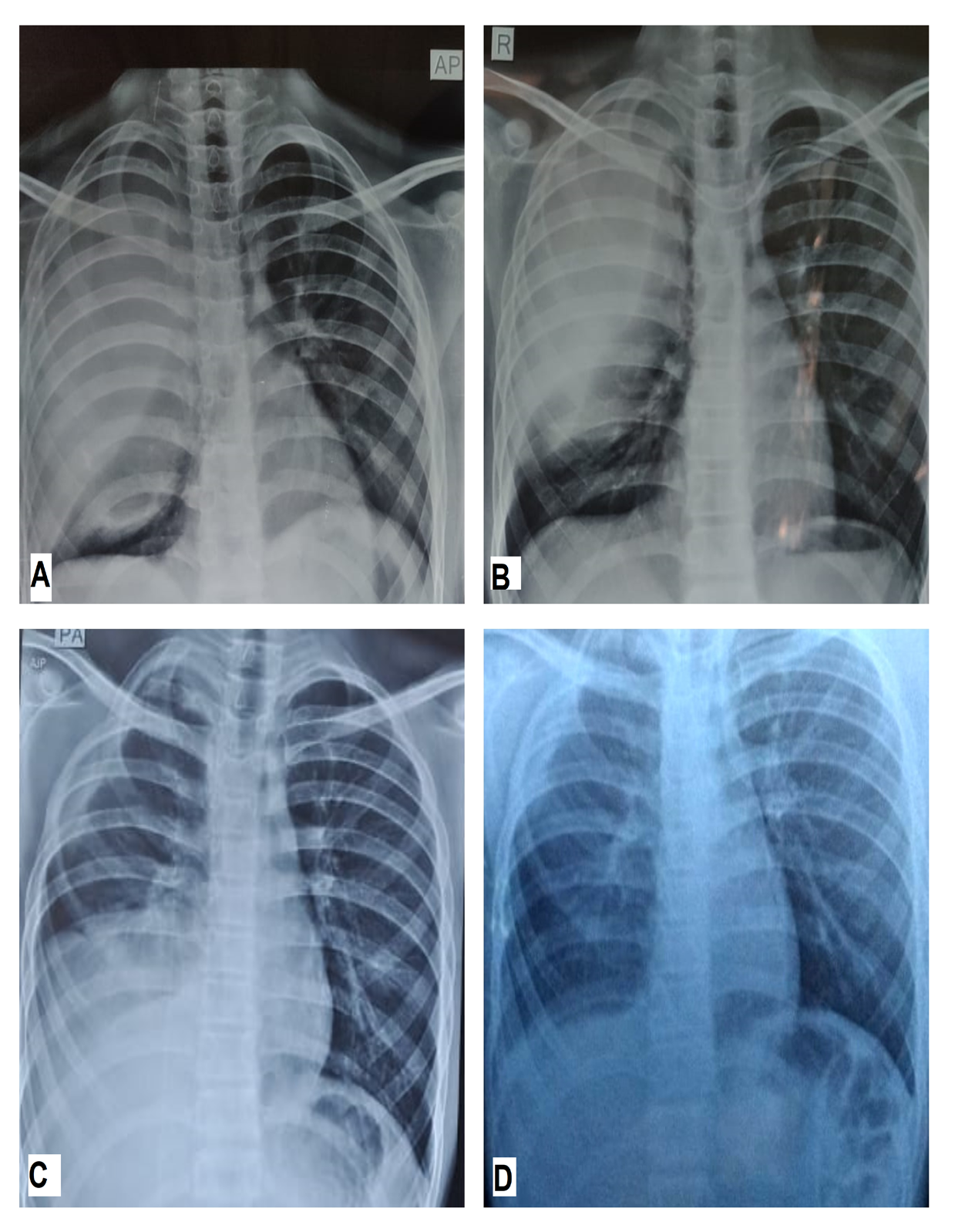 Figure 1: A) Chest X-ray postero-anterior view at diagnosis B) Chest X-ray postero-anterior view, post 4 cycles of neo-adjuvant chemotherapy C) Chest X-ray postero-anterior view at recurrence D) Chest X-ray postero-anterior view after 4 cycles of second line chemotherapy.