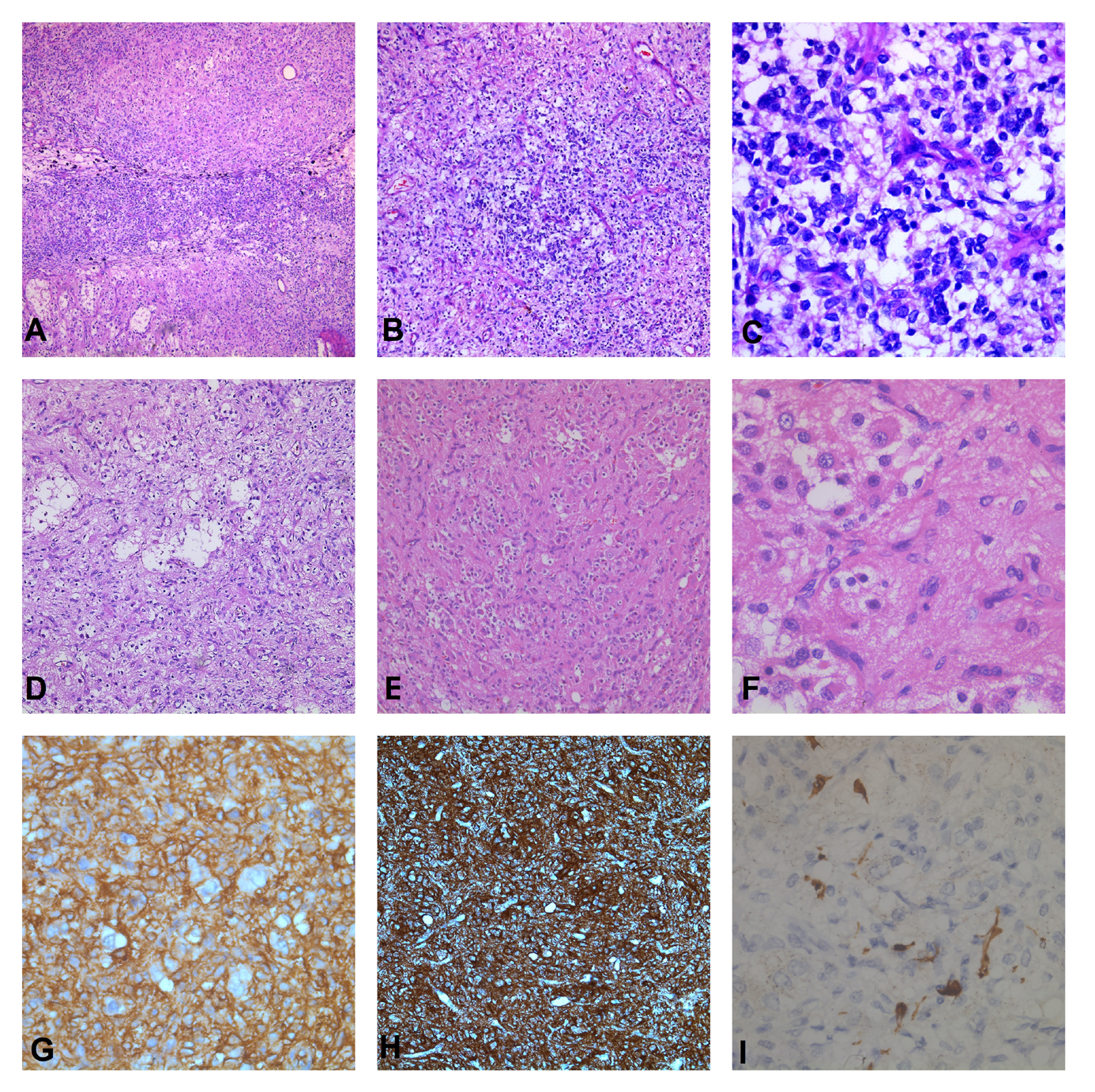 Figure 2: A-F) Histopathology of the resection specimen, H&E stain. A&B) Two components of the tumour with loosely cellular ‘pink’ areas (black star) and ‘blue’ cell areas (red star), 40X and 100X C) Small cells with hyperchromatic, round to mildly ovoid nuclei and scant cytoplasm, 400X. D) Loosely cellular areas, 100X E) Large neuronal cells in a fibrillary matrix, 200X F) Ganglion cells (arrow) set in a fibrillary matrix, 400X.