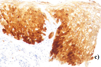 Figure 3: A characteristic case. a)	 The cytology showed ASC-H with hyper-chromatin in nuclei (Papanicolaou staining, ×200). b)	 A colposcope-targeted biopsy revealed CIN3 with hyper- chromatic nuclei cells in all layers (Hematoxylin & Eosin staining, ×50). c)	 The nuclei were positive for p16, suggesting HPV infection (sABC staining, ×50).
