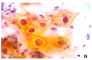 Figure 4: a. Shema of LEEP conization and evaporation. The cut line is indicated by a light blue dot line. The evaporation sites are indicated by blue dots. b. Before LEEP-conization, colposcopy findings showed thickened white epithelium with coarse punctation. c. Findings after hemostasis with LEEP conization. d. The area around the excised lesion was evaporated with the same ball electrode as widely as possible.