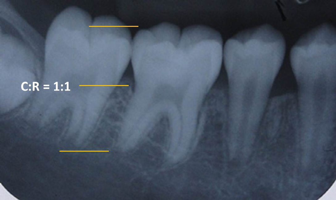 Figure 1: Photograph showing Rhyzomicroly/SRA in mandibular left first molar. Characteristics of SRA are shown in the picture: Crown: Root ratios – 1:1, closed and blunt apices.