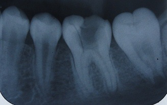 Figure 2: Permanent mandibular right first molar showing short root anomaly.