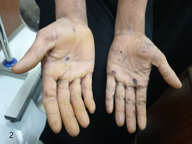 Figure 3: Collapsed bullae and hyperkeratosis.