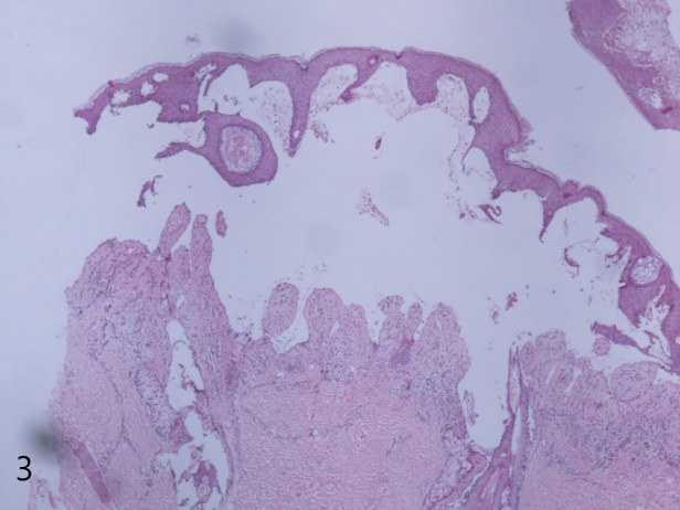 Figure 6: Subepidermal bulla, pseudoepitheliomatous hyperplasia. Dermis showing mild to moderate perivascular lymphocytes with occasional neutrophils and eosinophils.